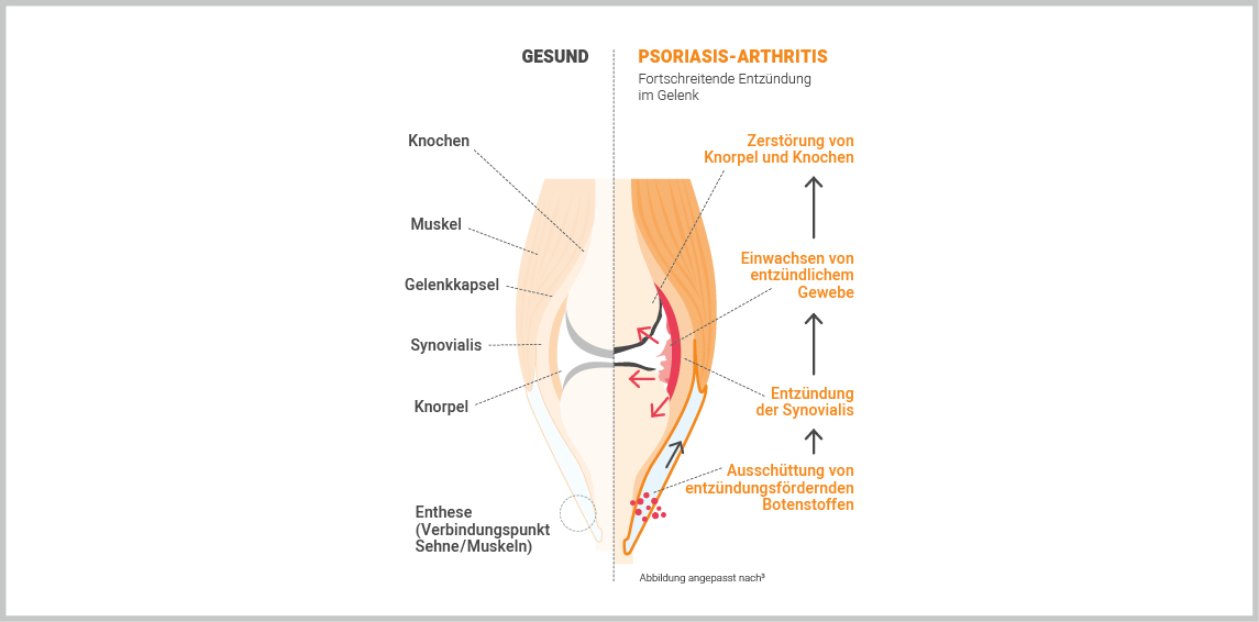 Die Psoriasis-Arthritis im Gelenk